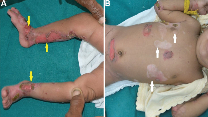 (A) Multiple erosions (yellow arrows) with crusts over the legs, ankle and dorsum of feet. (B) A few post-inflammatory hypopigmented macules (white arrows) over the trunk.
